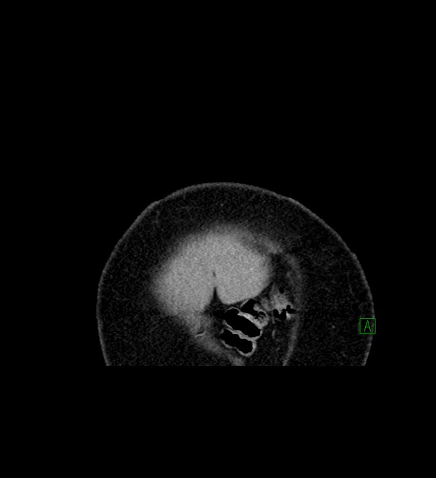 Chromophobe renal cell carcinoma (Radiopaedia 84239-99519 C 3).jpg