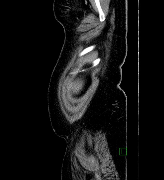 Chromophobe renal cell carcinoma (Radiopaedia 84239-99519 G 109).jpg