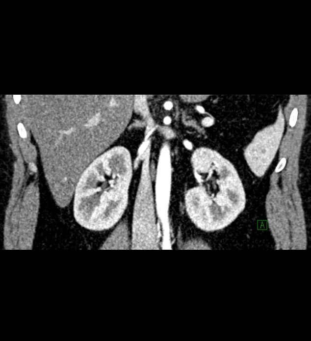 Chromophobe renal cell carcinoma (Radiopaedia 84286-99573 E 46).jpg