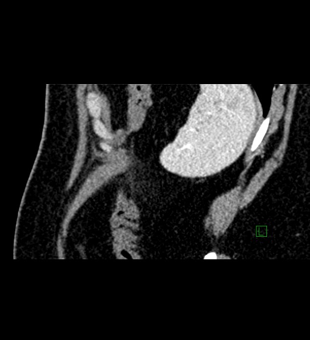 Chromophobe renal cell carcinoma (Radiopaedia 84286-99573 F 16).jpg