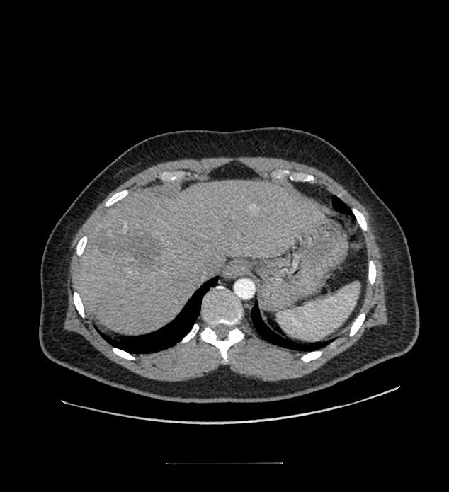 Chromophobe renal cell carcinoma (Radiopaedia 84337-99644 B 11).jpg