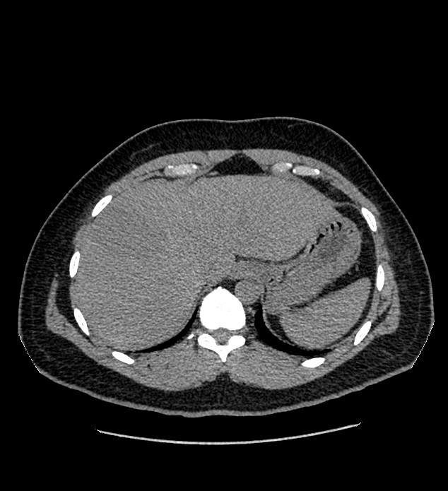 Chromophobe renal cell carcinoma (Radiopaedia 84337-99693 Axial non-contrast 13).jpg