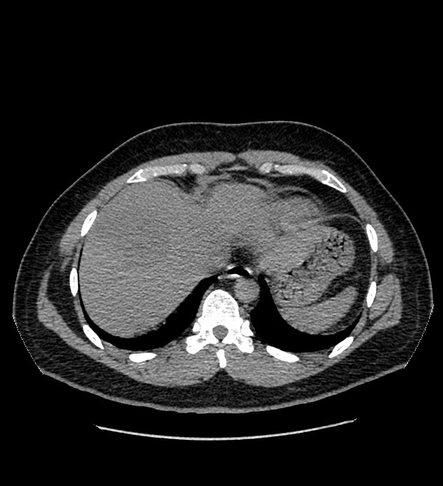 Chromophobe renal cell carcinoma (Radiopaedia 84337-99693 Axial non-contrast 7).jpg