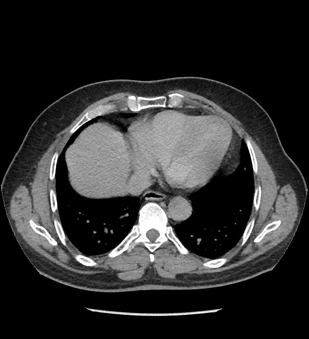 Chromophobe renal cell carcinoma (Radiopaedia 86879-103083 D 3).jpg