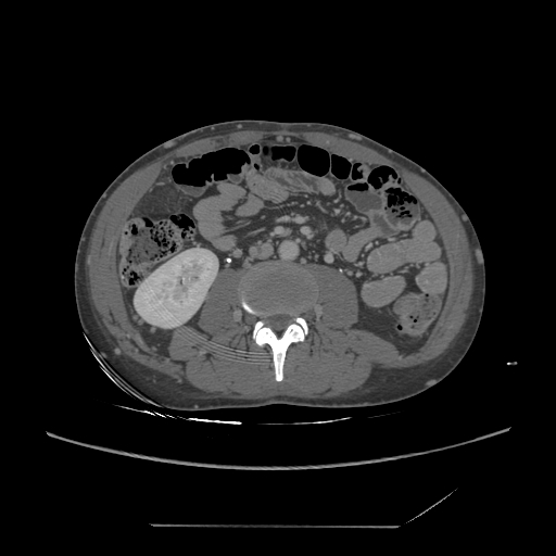 File:Chronic IVC thrombosis and resultant IVC filter malposition (Radiopaedia 81158-94800 A 116).jpg