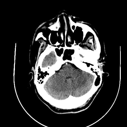 Chronic invasive fungal sinusitis (Radiopaedia 91563-109286 B 20).jpg