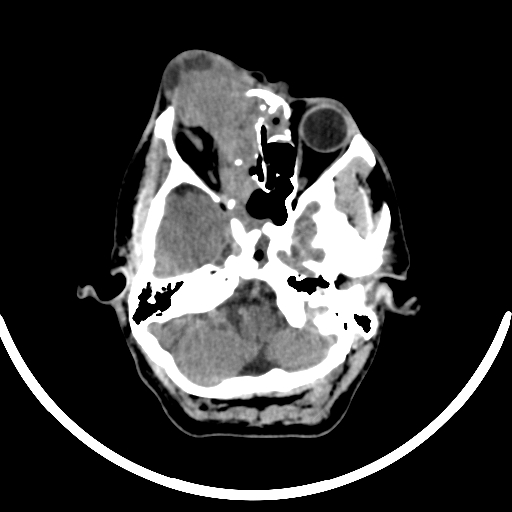 File:Chronic invasive fungal sinusitis with intraorbital and intracranial extension (Radiopaedia 56387-63046 Axial non-contrast 119).jpg