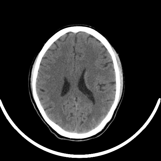 Chronic invasive fungal sinusitis with intraorbital and intracranial extension (Radiopaedia 56387-63046 Axial non-contrast 233).jpg