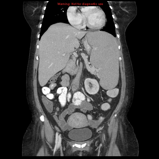 File:Chronic myeloid leukemia with splenic infarction (Radiopaedia 9178-9874 E 26).jpg