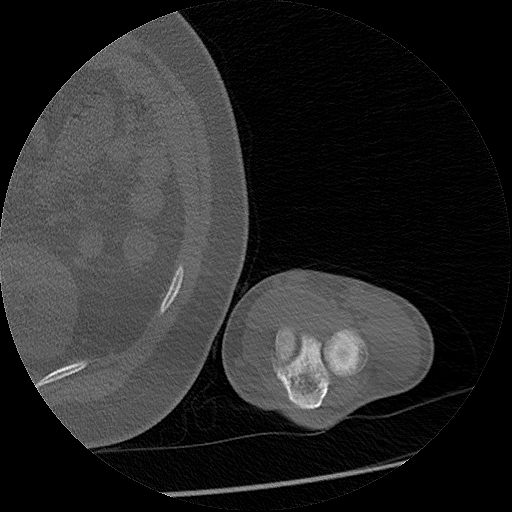 Chronic osteomyelitis (Radiopaedia 67597-76998 Axial bone window 74).jpg