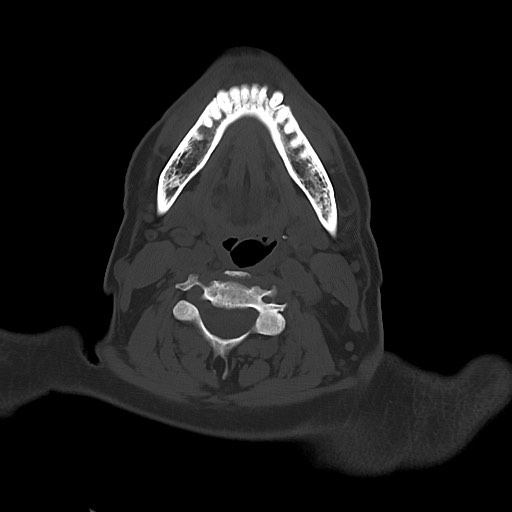 Chronic osteomyelitis - calvarial (severe) (Radiopaedia 69668-79616 Axial bone window 5).jpg