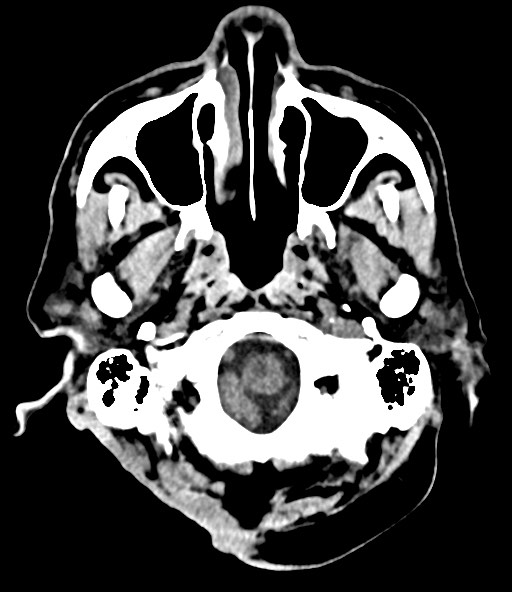 File:Chronic osteomyelitis - calvarial (severe) (Radiopaedia 69668-79616 Axial non-contrast 26).jpg