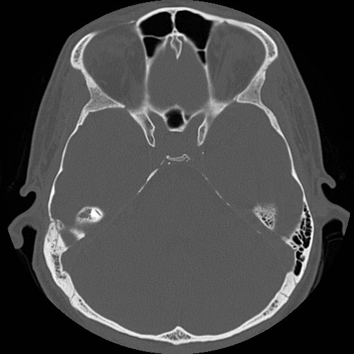 File:Chronic otomastoiditis (Radiopaedia 27138-27309 Axial bone window 49).jpg