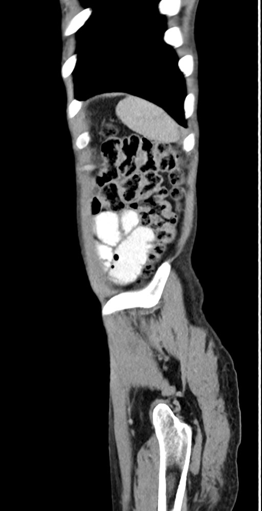 Chronic small bowel volvulus (Radiopaedia 75224-86322 C 22).jpg