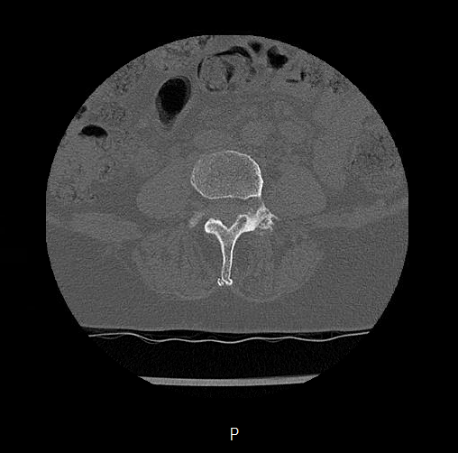 File:Chronic spinal hematoma with cauda equina syndrome (Radiopaedia 75745-88197 Axial bone window 33).png