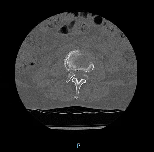 Chronic spinal hematoma with cauda equina syndrome (Radiopaedia 75745-88197 Axial bone window 7).png
