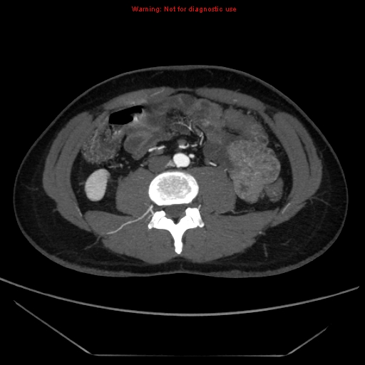 File:Circumaortic left renal vein (Radiopaedia 9069-9792 A 40).jpg