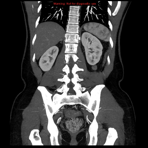 File:Circumaortic left renal vein (Radiopaedia 9069-9792 B 31).jpg