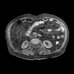 Cirrhosis and hepatocellular carcinoma in the setting of hemochromatosis (Radiopaedia 75394-86594 Axial T1 C+ fat sat 10).jpg