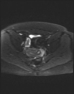 Class II Mullerian duct anomaly- unicornuate uterus with rudimentary horn and non-communicating cavity (Radiopaedia 39441-41755 Axial DWI 16).jpg