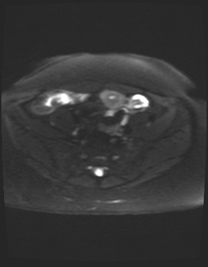 File:Class II Mullerian duct anomaly- unicornuate uterus with rudimentary horn and non-communicating cavity (Radiopaedia 39441-41755 Axial DWI 6).jpg