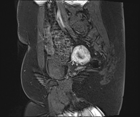 File:Class II Mullerian duct anomaly- unicornuate uterus with rudimentary horn and non-communicating cavity (Radiopaedia 39441-41755 G 81).jpg