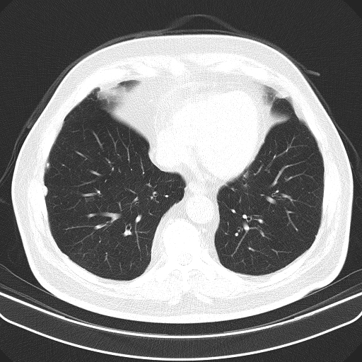 Classic complicated silicosis (Radiopaedia 49720-54961 Axial lung window 42).jpg