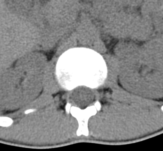 File:Clear cell meningoma - lumbar spine (Radiopaedia 60116-67691 Axial non-contrast 10).png