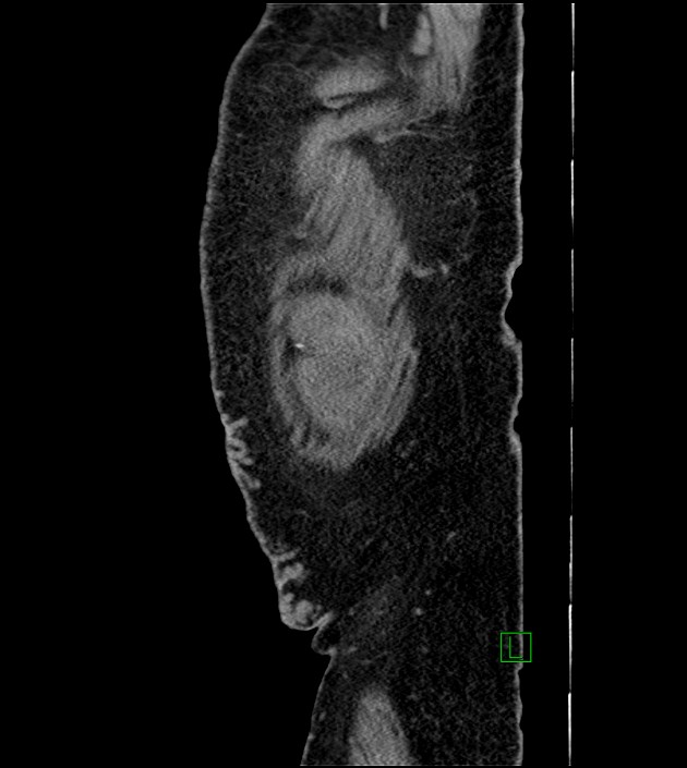 Closed-loop small bowel obstruction-internal hernia (Radiopaedia 78439-91096 C 15).jpg