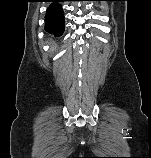 Closed loop obstruction - internal hernia into nephrectomy bed (Radiopaedia 59867-67320 B 127).jpg
