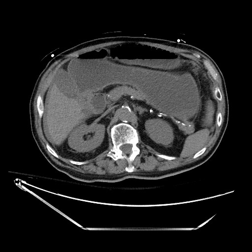 File:Closed loop obstruction due to adhesive band, resulting in small bowel ischemia and resection (Radiopaedia 83835-99023 Axial non-contrast 51).jpg