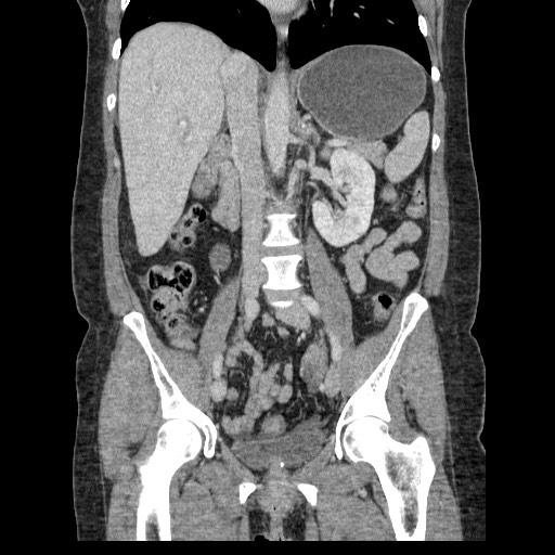 Closed loop small bowel obstruction (Radiopaedia 65403-74451 B 60).jpg