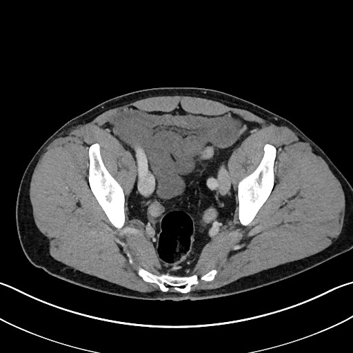 Closed loop small bowel obstruction - internal hernia (Radiopaedia 57806-64778 B 107).jpg