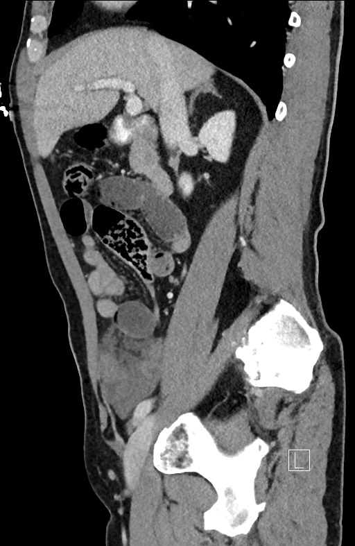 Closed loop small bowel obstruction - internal hernia (Radiopaedia 57806-64778 C 73).jpg