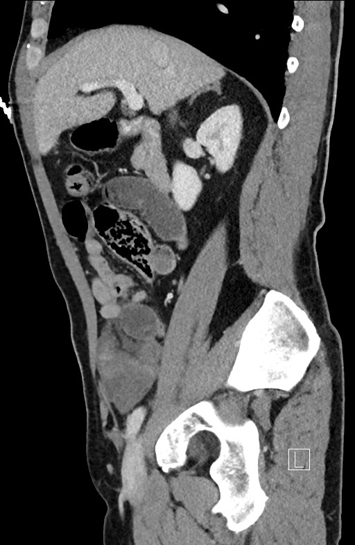 Closed loop small bowel obstruction - internal hernia (Radiopaedia 57806-64778 C 75).jpg