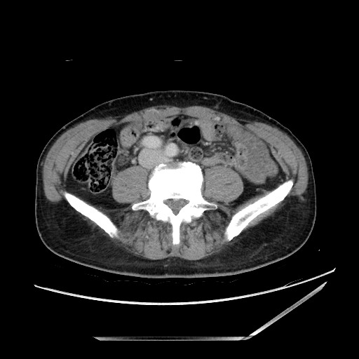 Closed loop small bowel obstruction - omental adhesion causing "internal hernia" (Radiopaedia 85129-100682 A 105).jpg