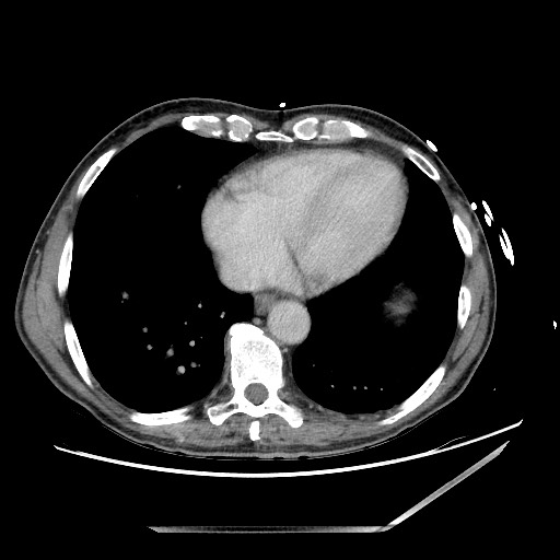 Closed loop small bowel obstruction - omental adhesion causing "internal hernia" (Radiopaedia 85129-100682 A 5).jpg