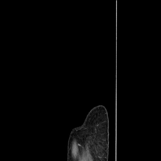 Closed loop small bowel obstruction - omental adhesion causing "internal hernia" (Radiopaedia 85129-100682 C 183).jpg