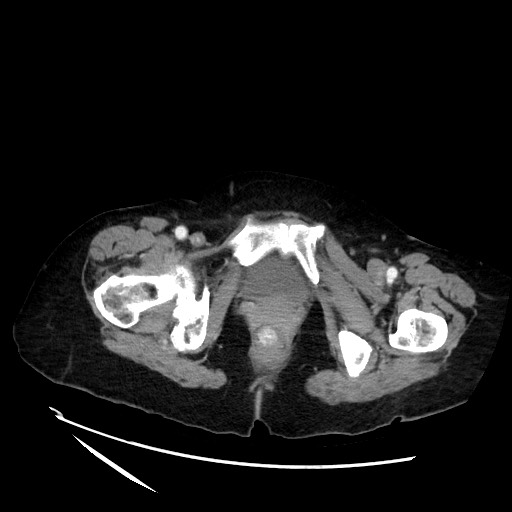 File:Closed loop small bowel obstruction due to adhesive band, with intramural hemorrhage and ischemia (Radiopaedia 83831-99017 Axial 142).jpg