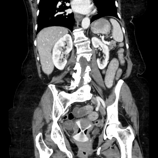 Closed loop small bowel obstruction due to adhesive band, with intramural hemorrhage and ischemia (Radiopaedia 83831-99017 C 80).jpg