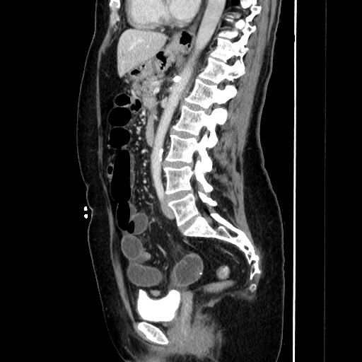 Closed loop small bowel obstruction due to adhesive bands - early and late images (Radiopaedia 83830-99015 C 99).jpg