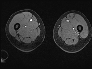 File:Closed loop small bowel obstruction in pregnancy (MRI) (Radiopaedia 87637-104031 G 66).jpg