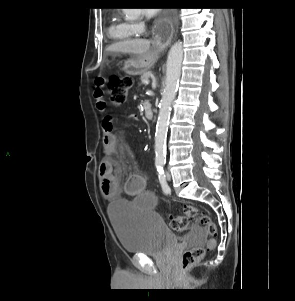 File:Closed loop small bowel obstruction with ischemia (Radiopaedia 84180-99456 C 49).jpg