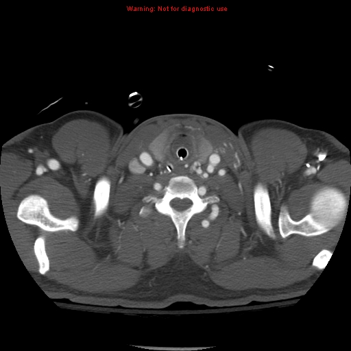 File:Coarctation of the aorta (Radiopaedia 8681-9490 B 5).jpg