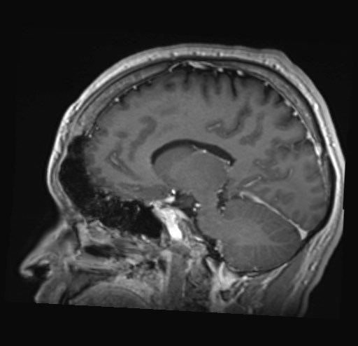 Cochlear incomplete partition type III associated with hypothalamic hamartoma (Radiopaedia 88756-105498 Sagittal T1 C+ 23).jpg