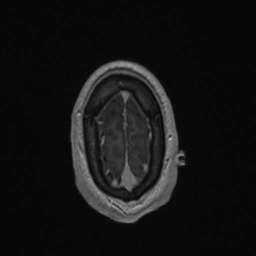Colloid cyst (Radiopaedia 44510-48181 Axial T1 C+ 164).png