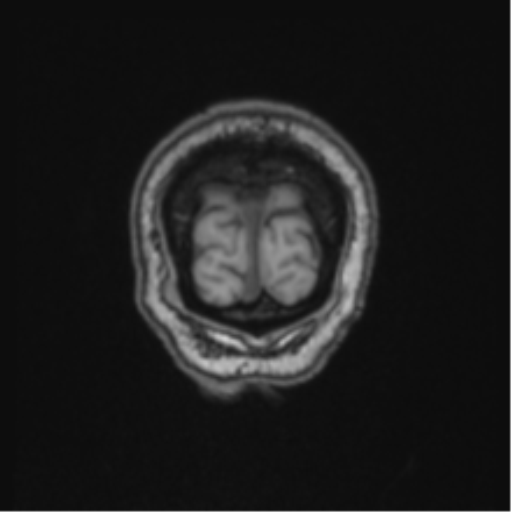 Colloid cyst of the third ventricle (Radiopaedia 86571-102662 Coronal T1 8).png