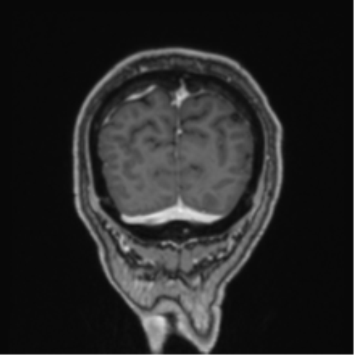 File:Colloid cyst of the third ventricle (Radiopaedia 86571-102662 Coronal T1 C+ 14).png