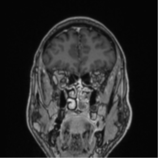 File:Colloid cyst of the third ventricle (Radiopaedia 86571-102662 Coronal T1 C+ 73).png