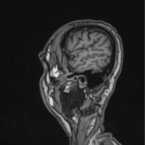 Colloid cyst of the third ventricle (Radiopaedia 86571-102662 Sagittal T1 11).png